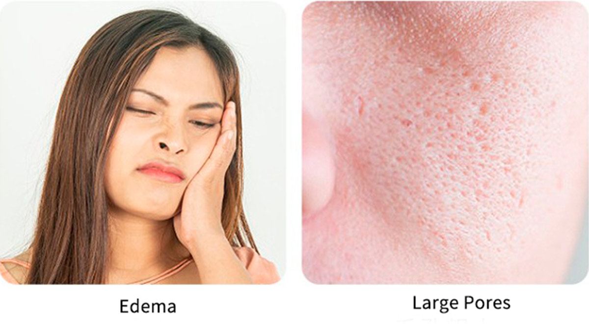 Silicone Ice Roller for Face